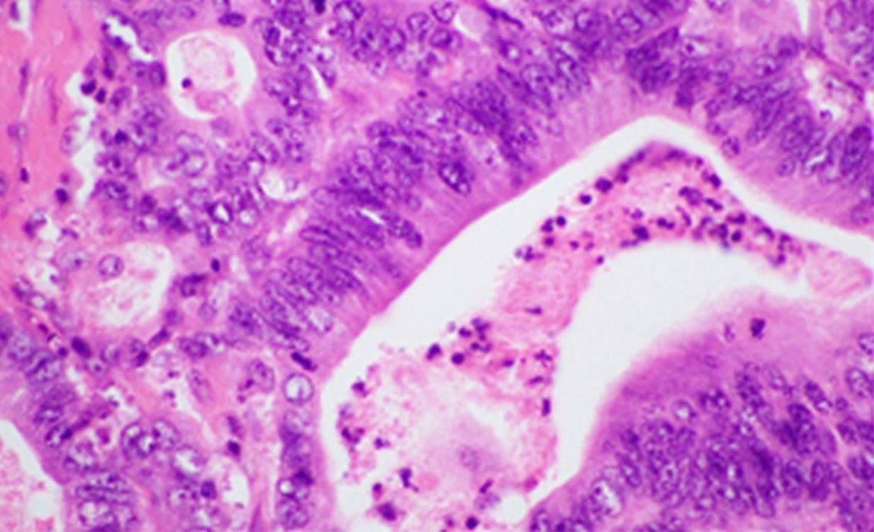 Experimental Drug Generates Immune Response Against Pancreatic Cancer in People at High Risk